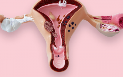 Fibromas uterinos y su tratamiento desde la alopatía y desde la medicina natural