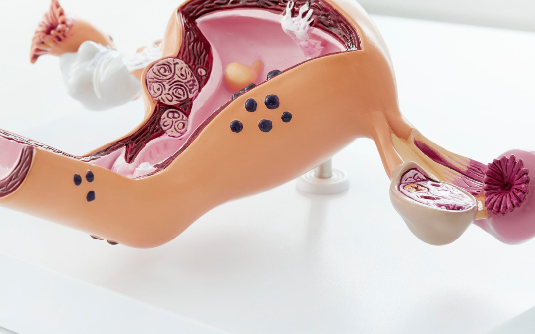 Endometriosis y ovario poliquístico