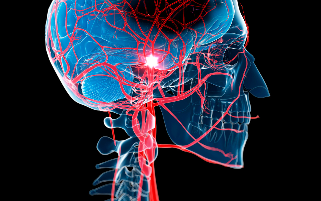 Las mujeres con endometriosis tienen un 34% más de riesgo de sufrir un accidente cerebrovascular (ACV) que aquellas sin la afección inflamatoria crónica.