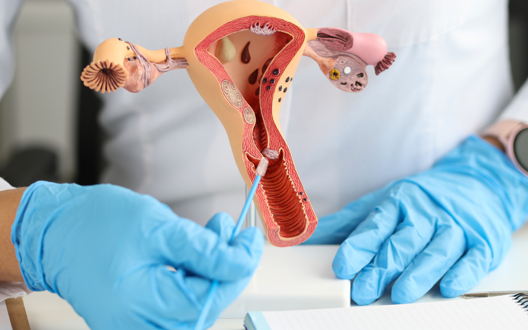 Nuevos estudios muestran que la fibrosis podría estar relacionada con varios mecanismos en la fisiopatología de la endometriosis