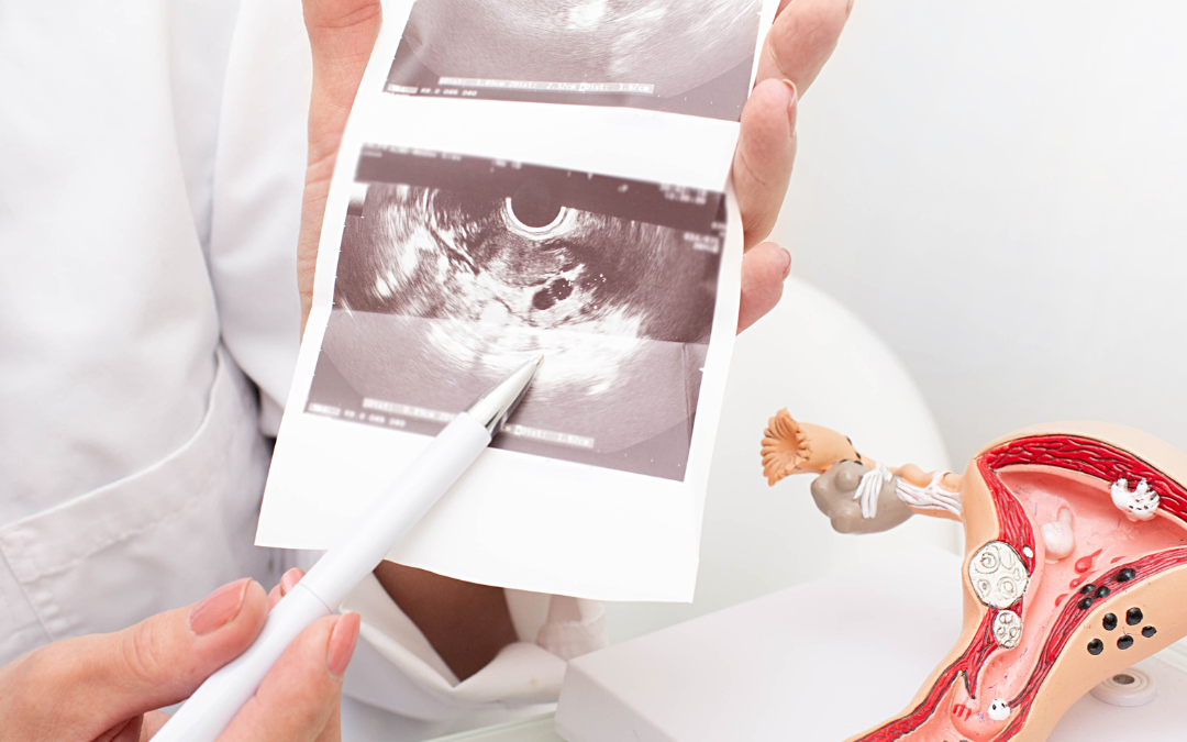 Vinculan Síndrome de ovario poliquístico a la infertilidad, la obesidad y la diabetes