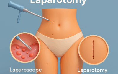 Laparoscopia vs. Laparotomía en el manejo de la endometriosis: lo que debes saber